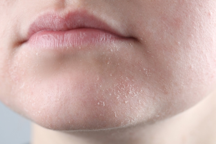 Dry flaky skin caused by hard water mineral buildup not removed by salt-free water softener